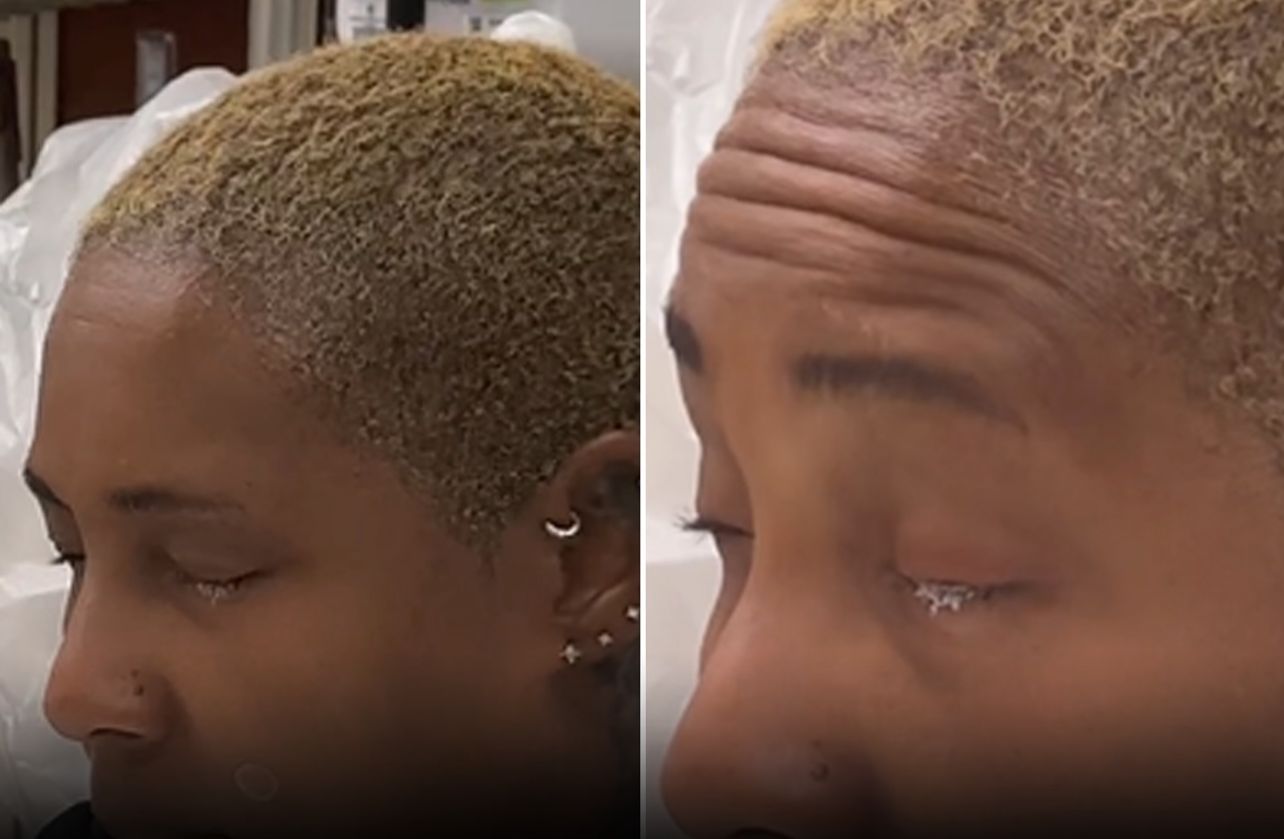 Mulher confunde colírio com cola e fica com olho fechado por quase 2 meses após colar pálpebras